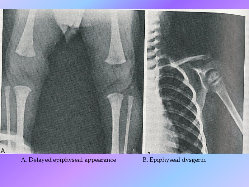 A. Delayed epiphyseal appearance          